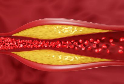cholesterol-plaque-buildup-2200x1200
