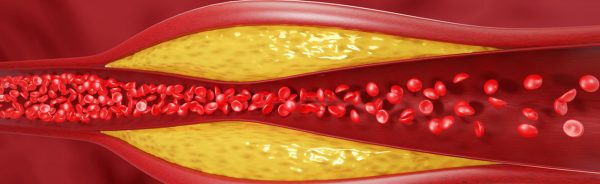cholesterol-plaque-buildup-2200x1200