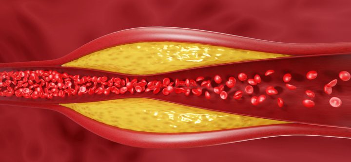 cholesterol-plaque-buildup-2200x1200