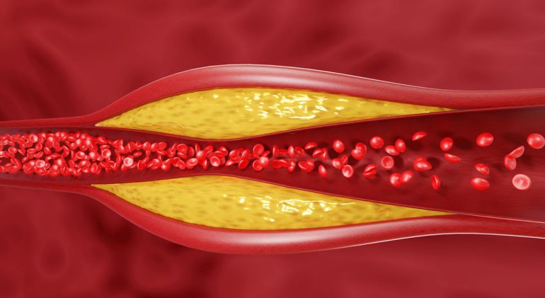 cholesterol-plaque-buildup-2200x1200